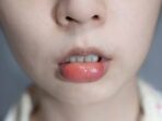 Ketika kalian mengalami bibir bengkak, ada beberapa upaya sederhana ini sebagai bentuk penanganan awal guna meredakan keluhan dan gejalanya.