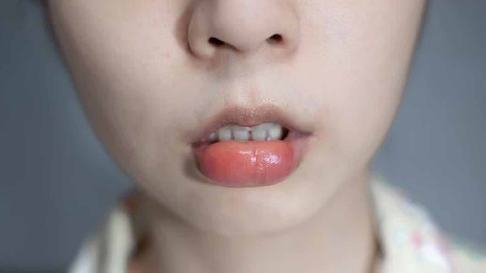 Ketika kalian mengalami bibir bengkak, ada beberapa upaya sederhana ini sebagai bentuk penanganan awal guna meredakan keluhan dan gejalanya.